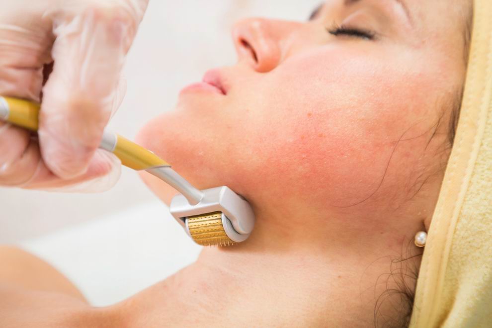 dermaroller-kezelés menete